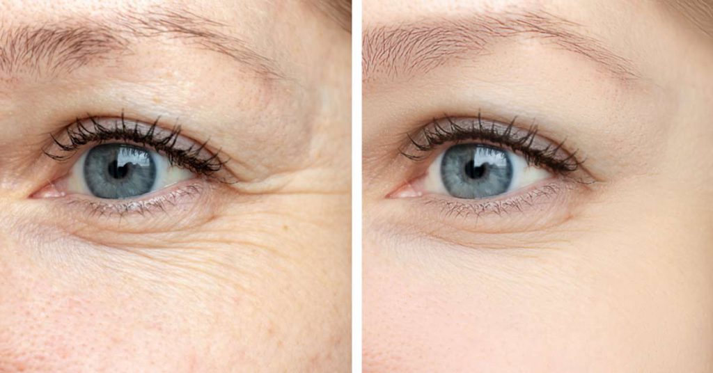 Imagem atual: Liftera contra Ultraformer Qual tratamento escolher