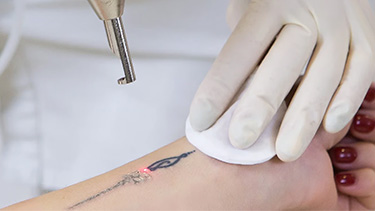 Laser Nd Yag QS - Dra. Karina Okita