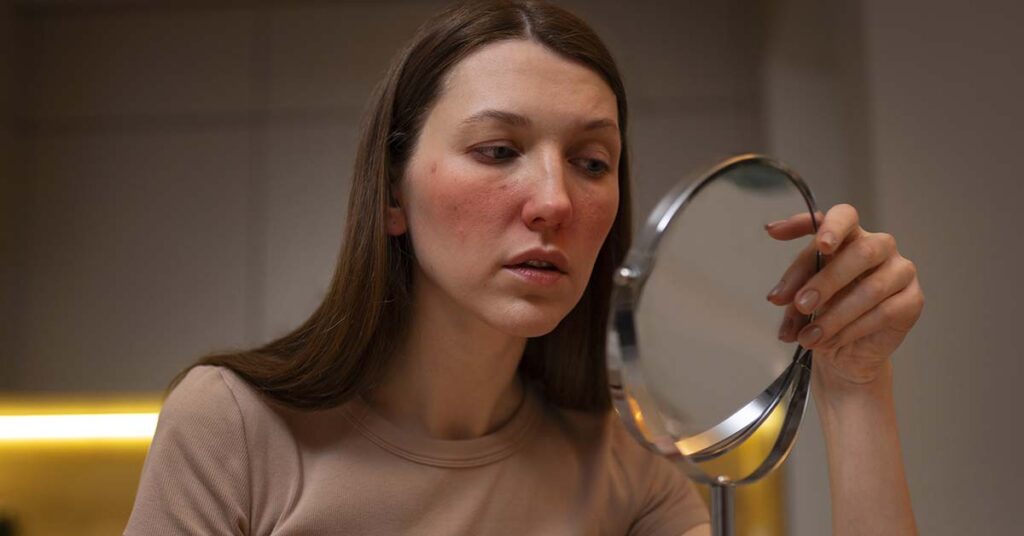 Rosácea que não passa com creme: quando considerar laser