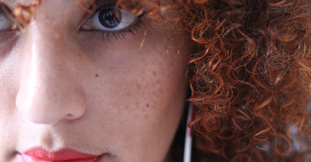Melasma: o que é, causas e quando procurar ajuda médica