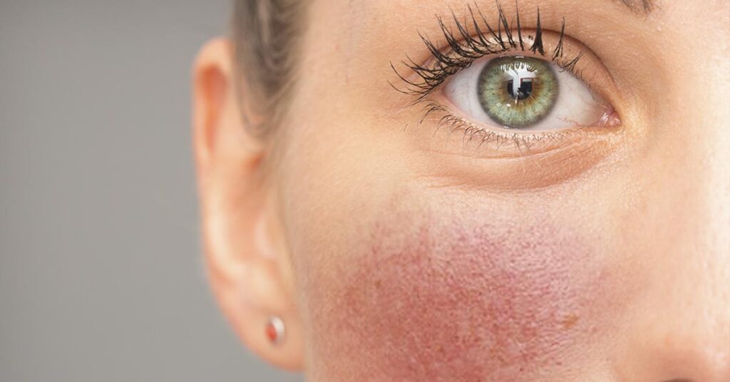 Rosácea: o que é, tipos, sintomas e tratamentos com dermatologista